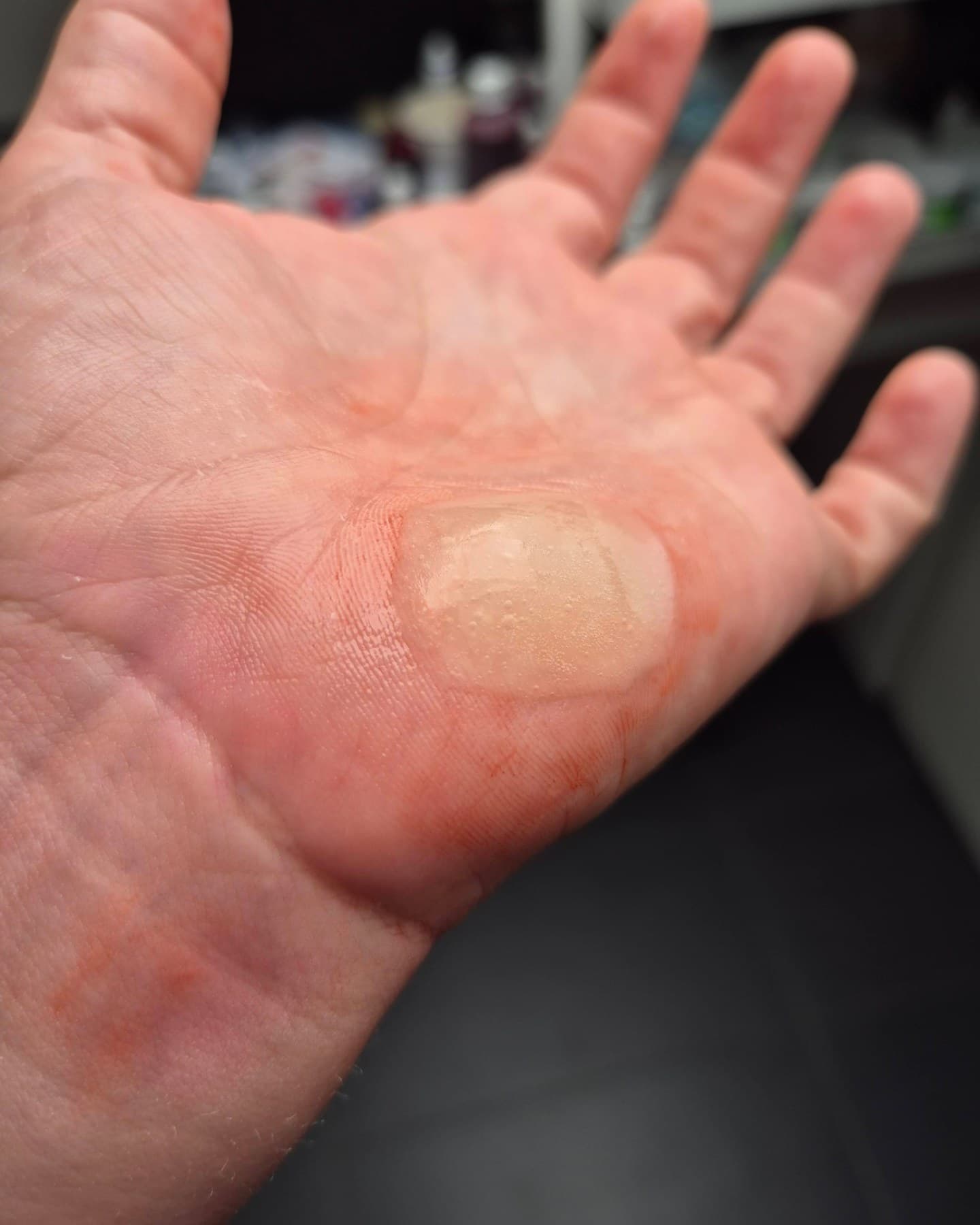 Brandblase · Handfläche